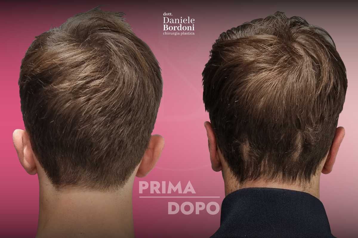 Otoplastica: foto prima e dopo | Dr. Daniele Bordoni