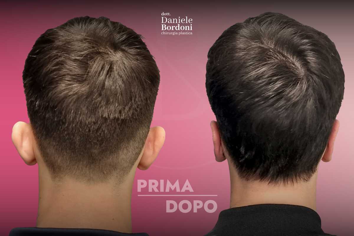 Otoplastica: foto prima e dopo | Dr. Daniele Bordoni