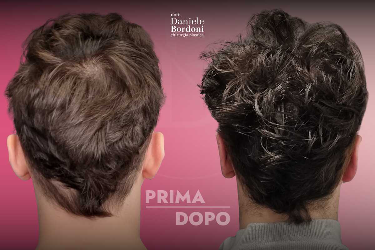 Otoplastica: foto prima e dopo | Dr. Daniele Bordoni