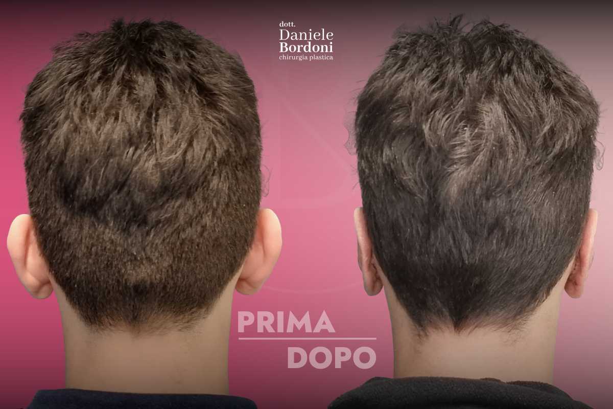 Otoplastica: foto prima e dopo | Dr. Daniele Bordoni