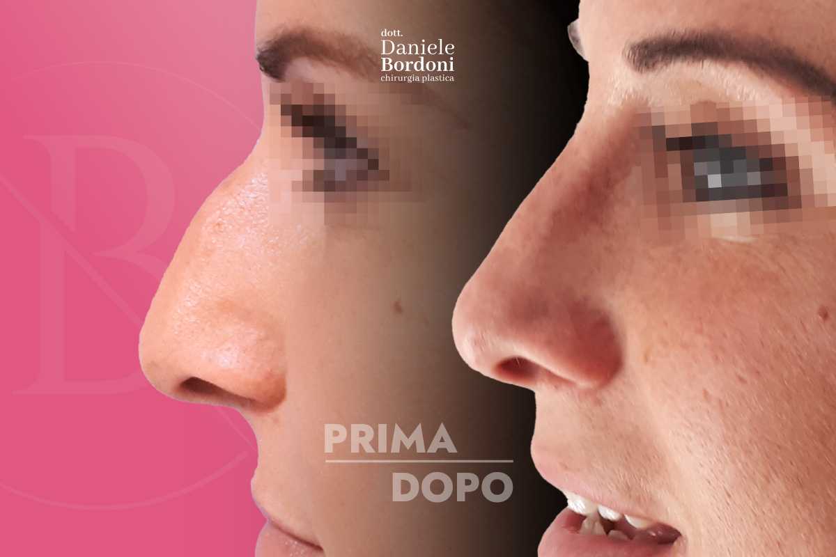 Rinoplastica: foto prima e dopo | Dr. Daniele Bordoni