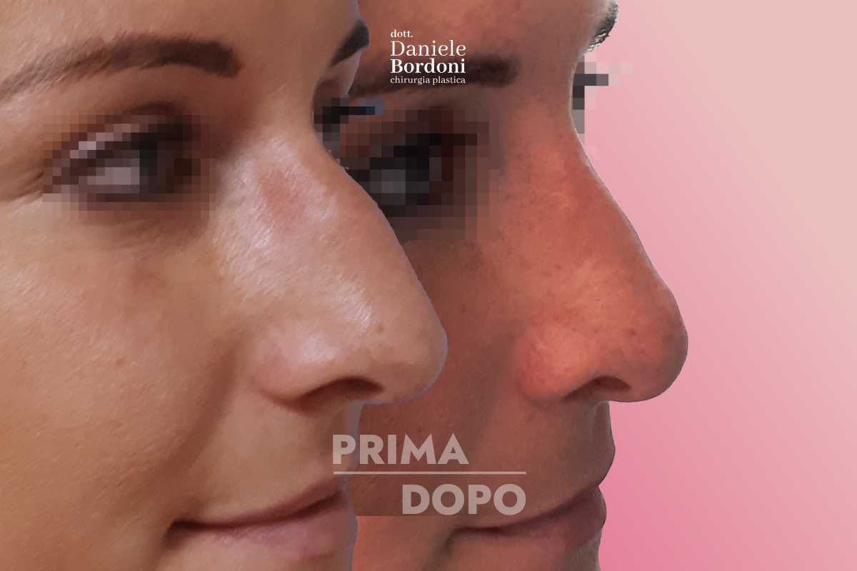 Rinoplastica: foto prima e dopo | Dr. Daniele Bordoni