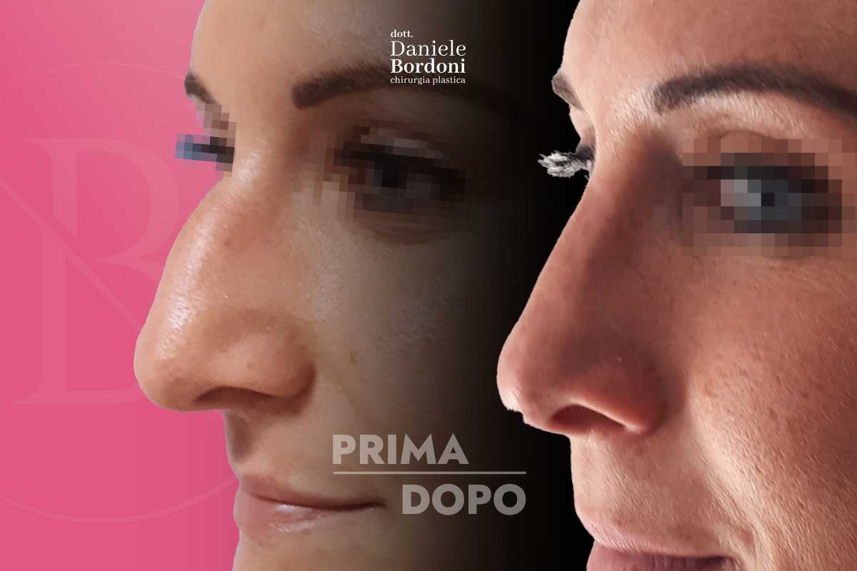 Rinoplastica: foto prima e dopo | Dr. Daniele Bordoni